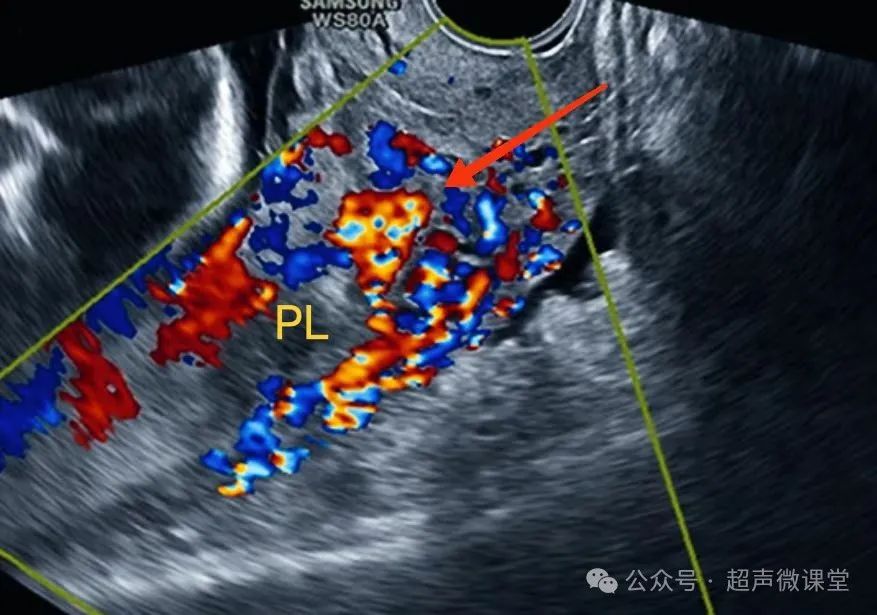 前置胎盘的超声诊断