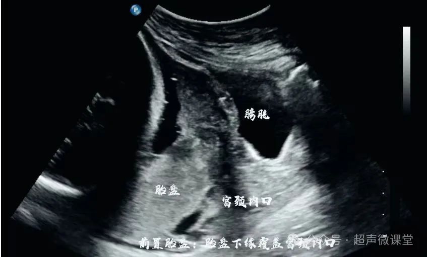 前置胎盘的超声诊断