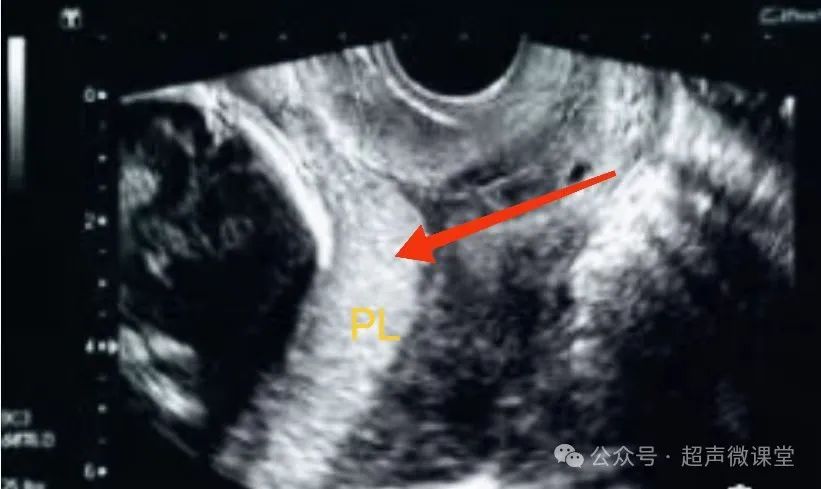 前置胎盘的超声诊断
