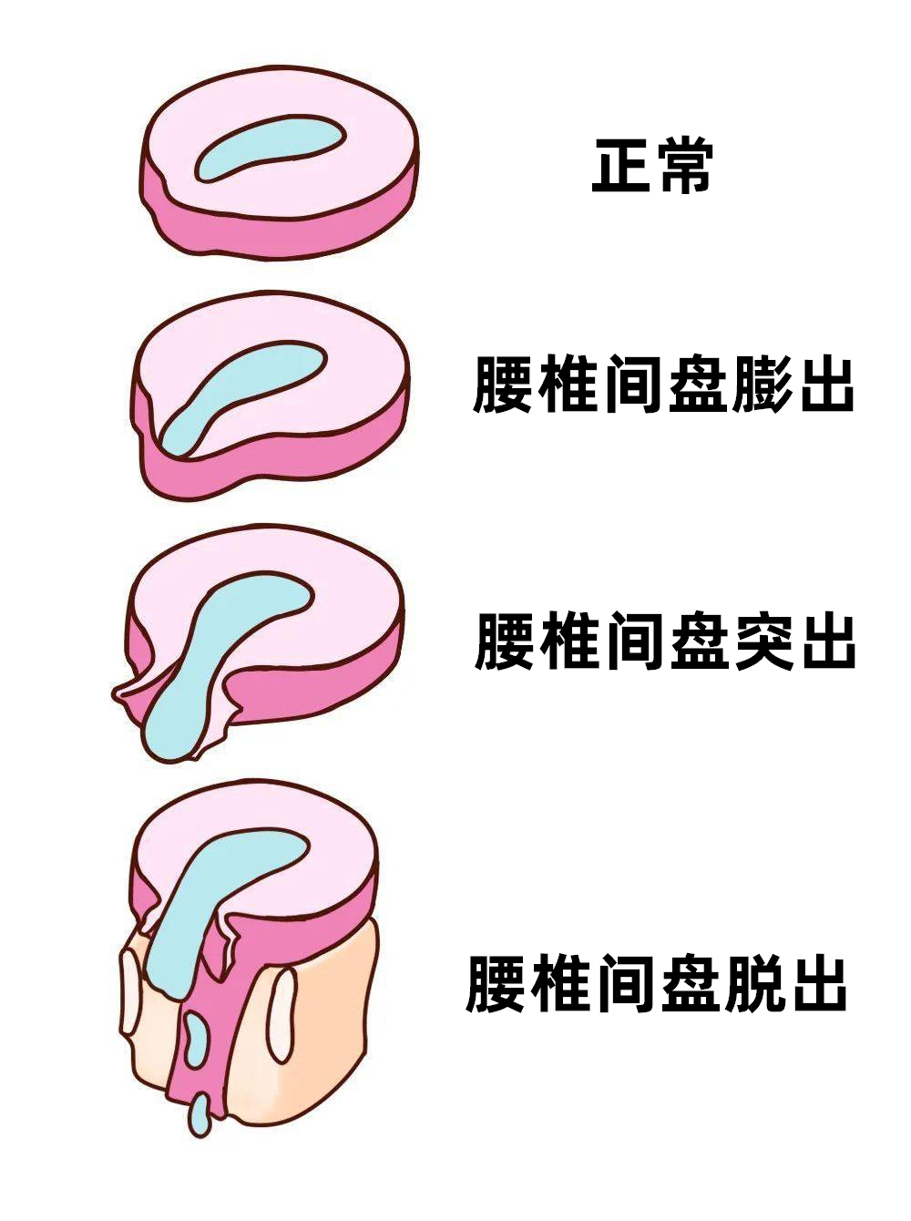 矢状位腰椎图片