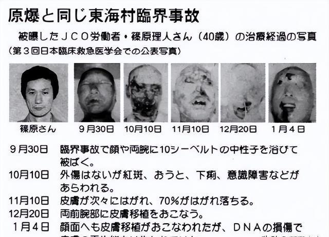 核辐射到底有多可怕?中国首例核辐射受害者:被切除了半个身体