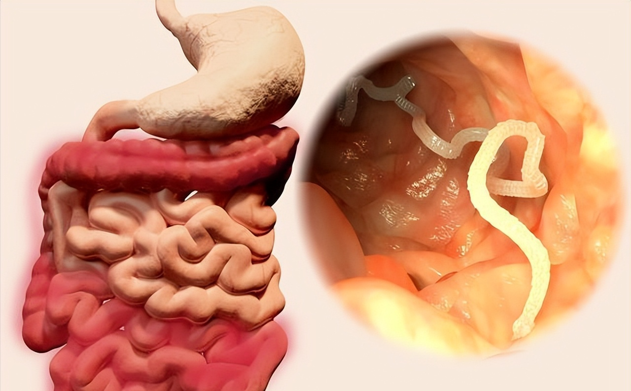 过去普遍的肠道寄生虫问题为何现今少见?