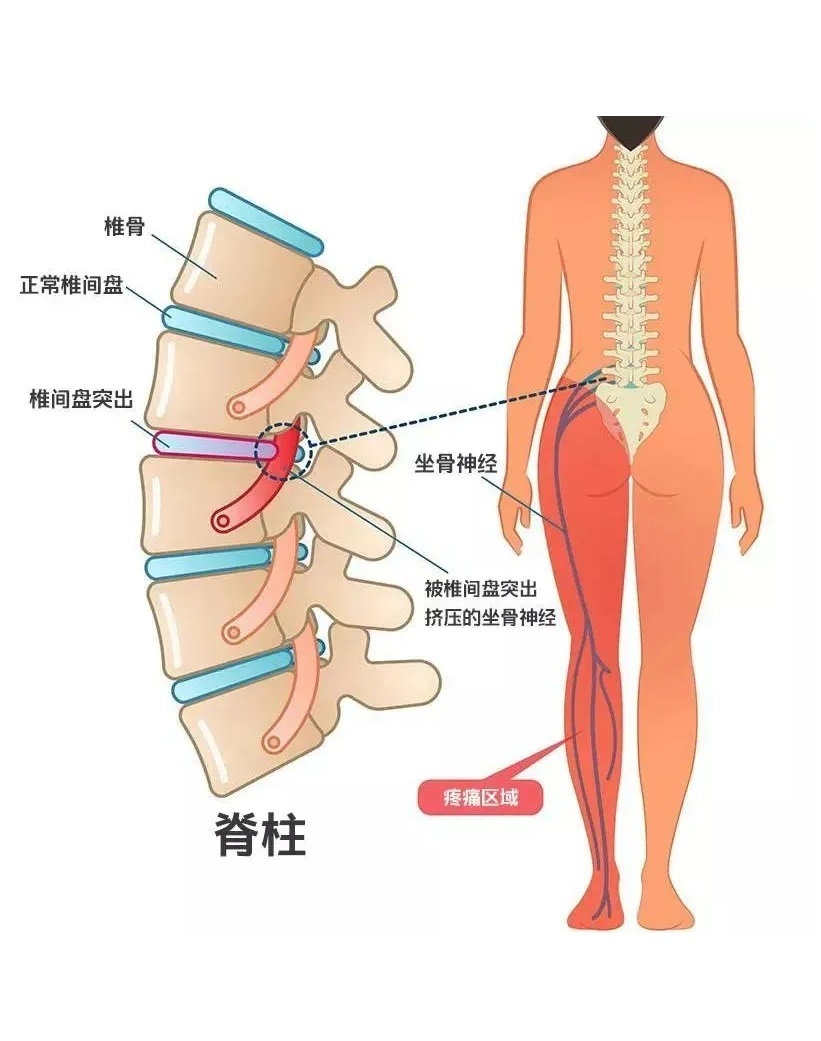 腰椎12345节的位置图片图片