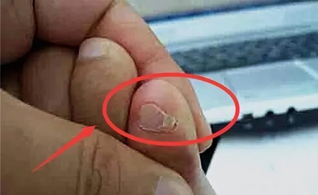 小脚趾指甲分成两瓣的人,到底什么来历?是纯种汉族人的证明吗?