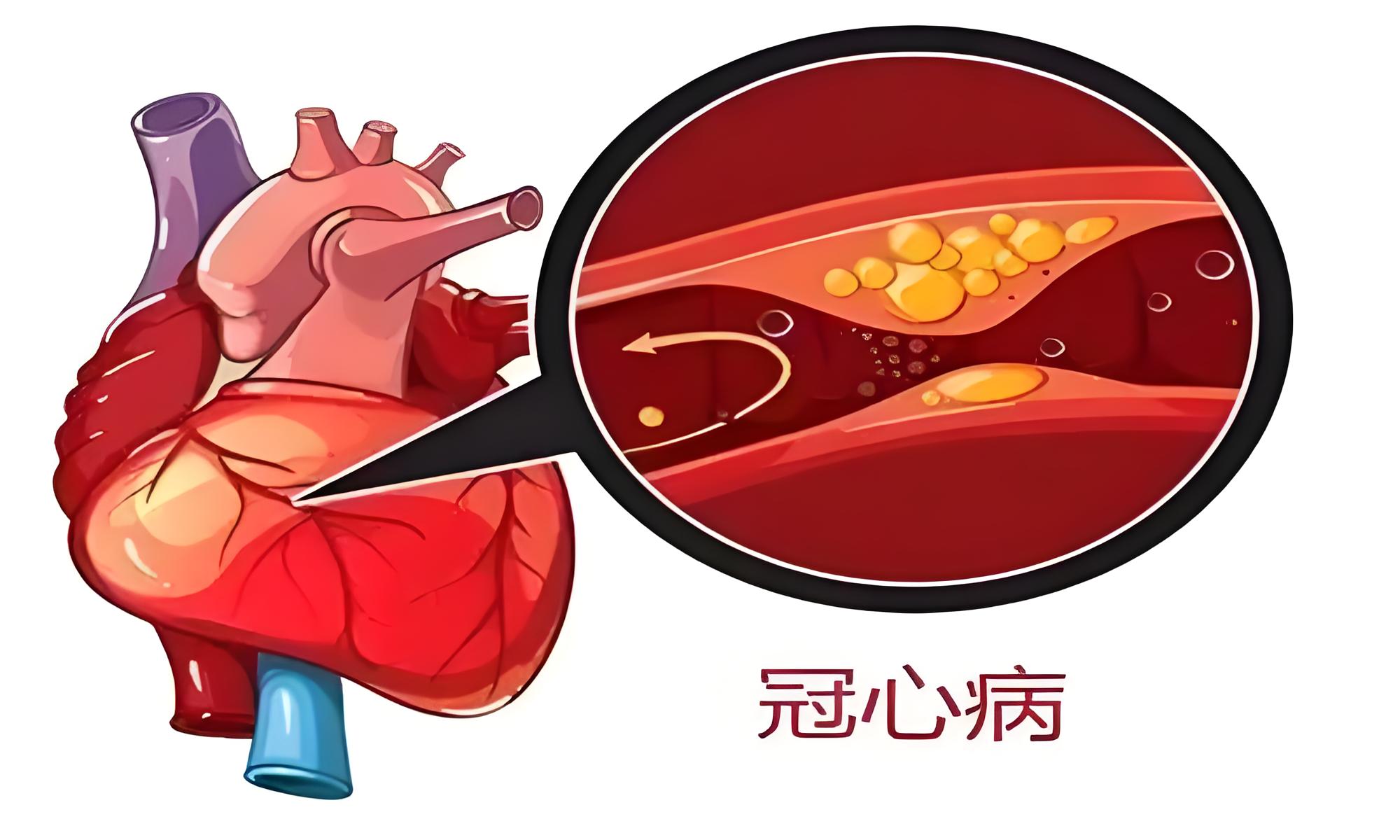 心绞痛 放射图片