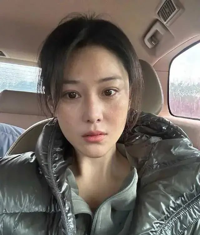 张馨予拍照晒头上的斑秃!37岁就长出了白发,曾自曝患脂溢性皮炎
