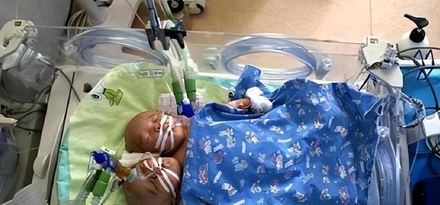 2011年,四川女子生下中国首例双头婴儿,之后怎么样了