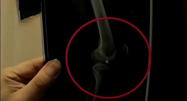 2016年,男子腿部中弹,深夜求医后,医生的一番话,让他立即报警