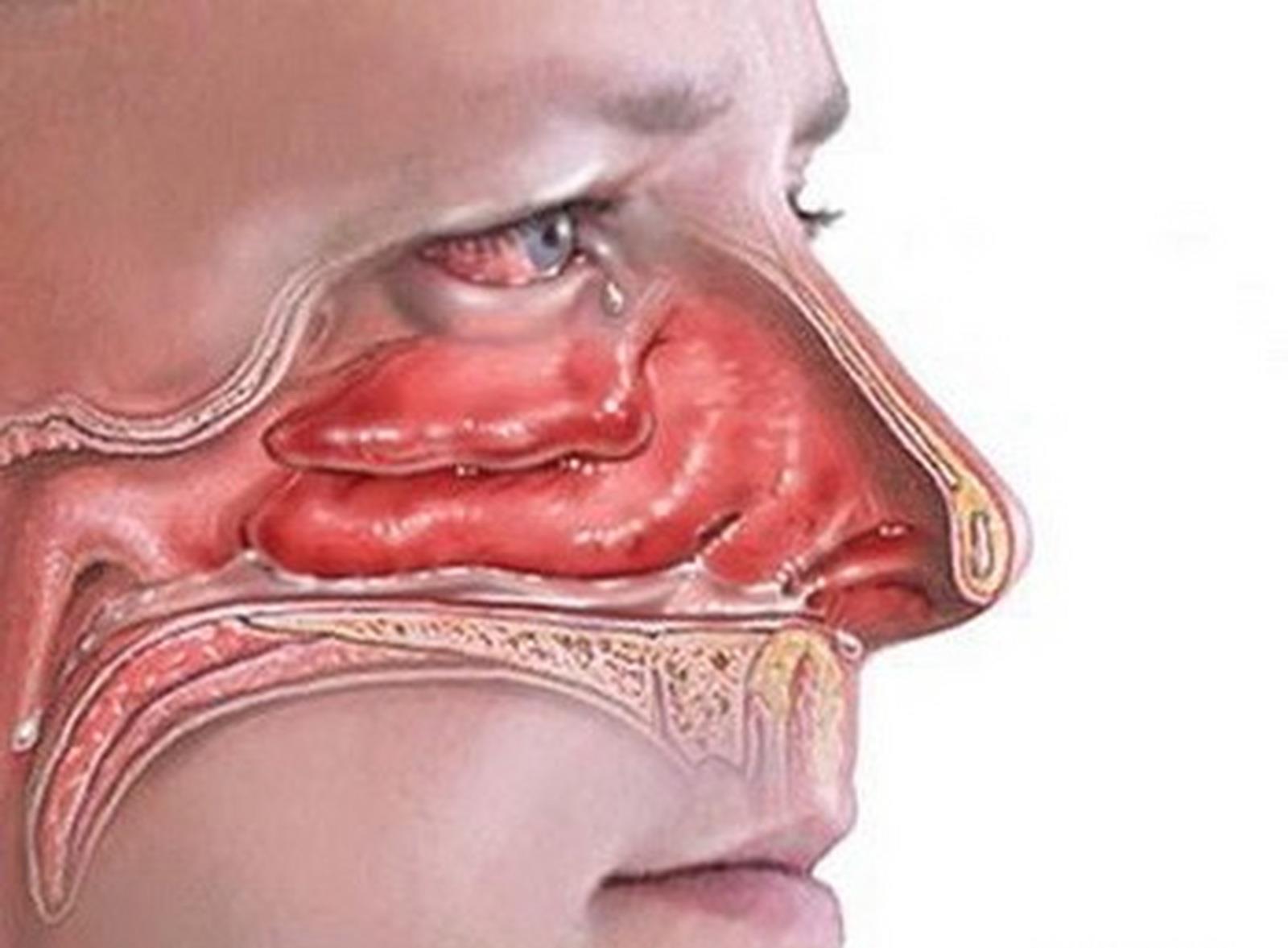 鼻腔粘膜常常干燥,结痂,流鼻血,分享一个大家都赞誉的简单方法