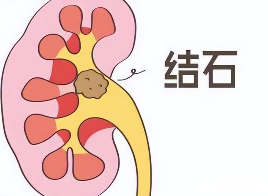 看排尿能就能看出肾结石?提醒:有结石的人,一般会出现3个异常