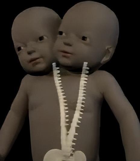 2011年,四川孕妇生下中国第一例"双头宝宝",最后怎么样了?
