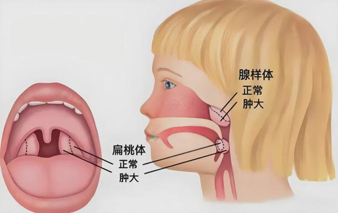 图书馆里的意外发现:一场关于腺样体肥大的健康探寻