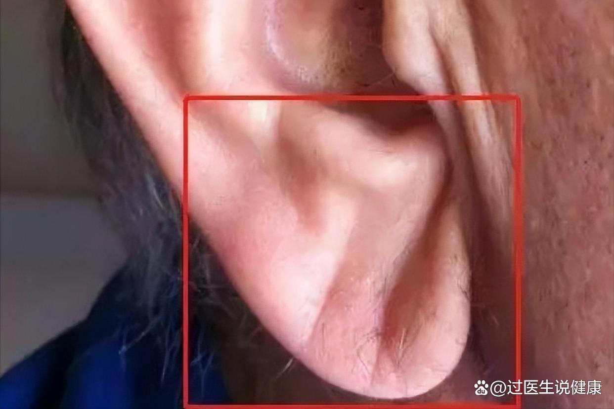 耳朵上有这条折痕,是心梗,猝死的"标志"?专家:不能划等号