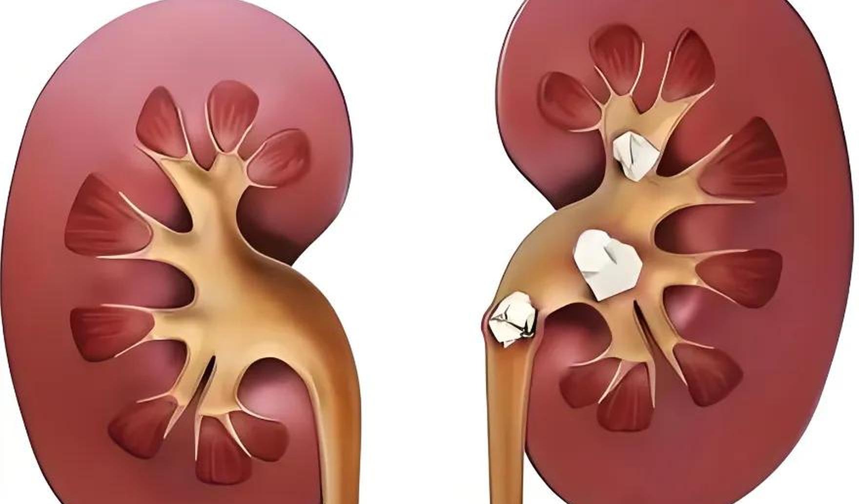 肾结石复发率高,日常饮食和喝水真的能防住吗?