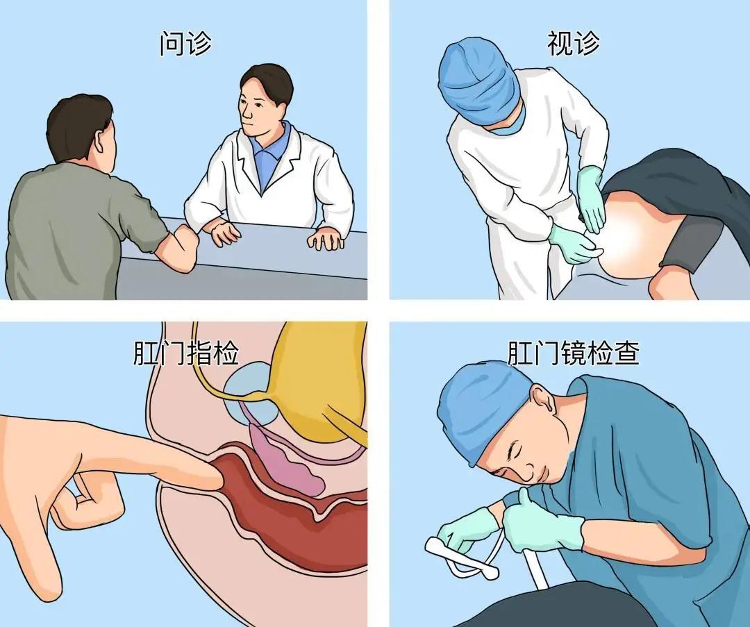 上海一女子肛检后称被性侵,是肛诊的错?关于肛诊,一次性说清楚