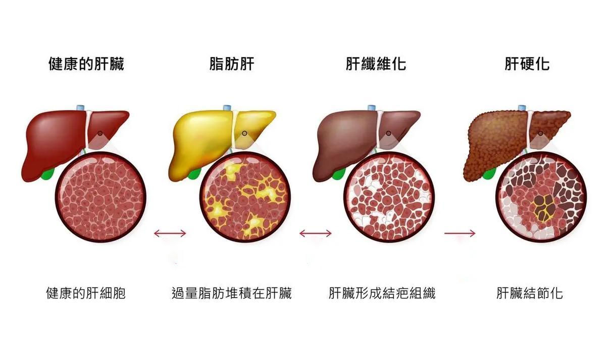 肝脂堆积加速恶疾风险！4.7亿人陷危机，双专利“吉利肝”成护肝关键