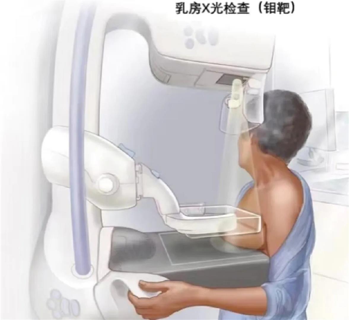平胸女生做钼靶检查有多疼?