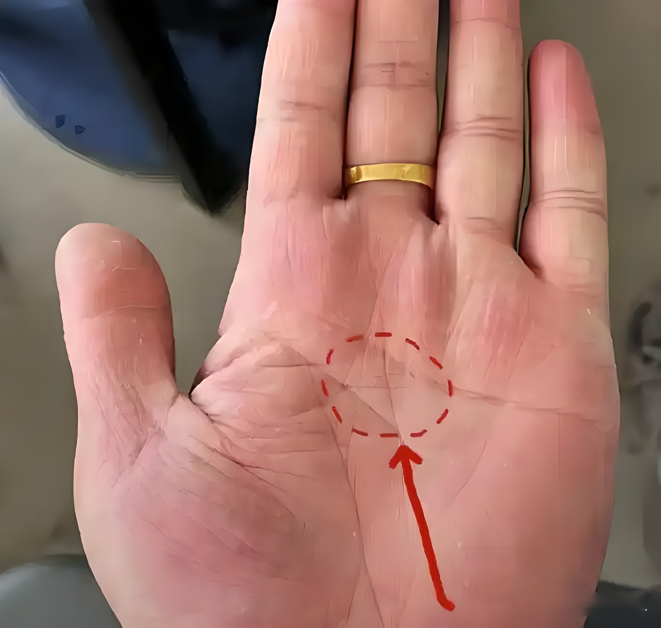 掌纹揭秘:手有「川字掌」?