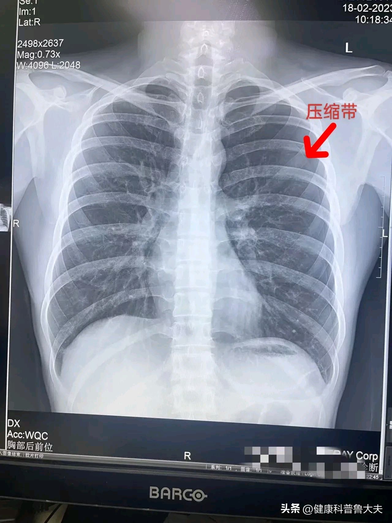 液气胸x线胸片图解图片