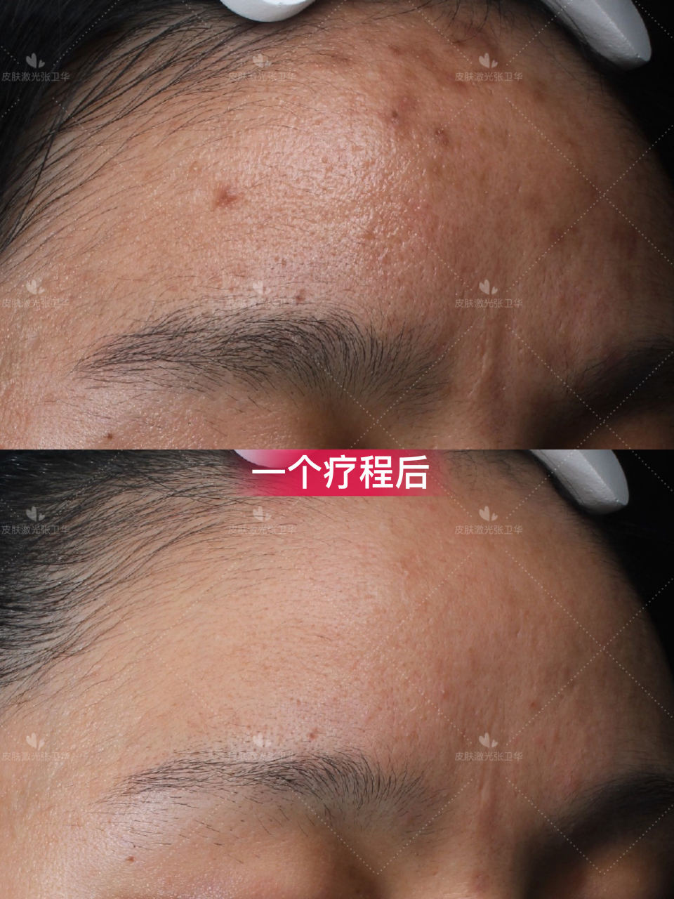 爱美的女生都好看# #点阵激光# #色沉