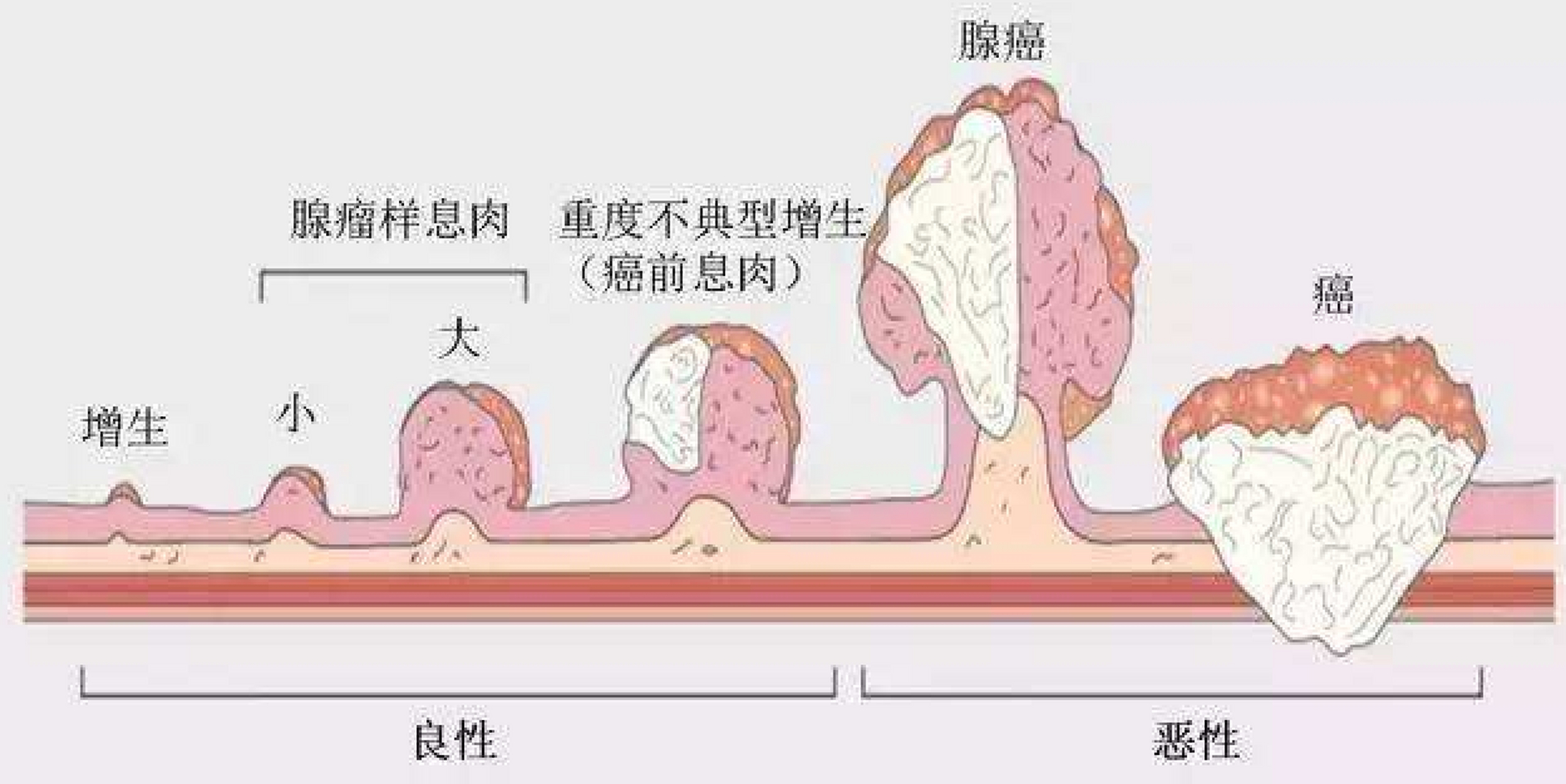 肠息肉有何症状?