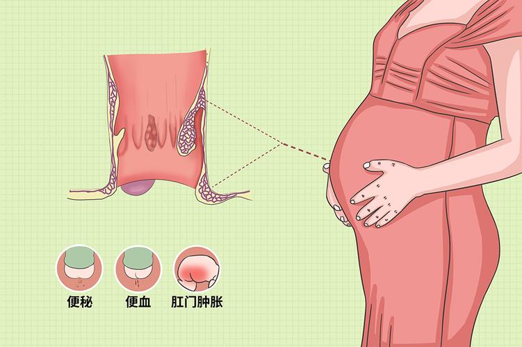 孕后痔疮如何预防和治疗?