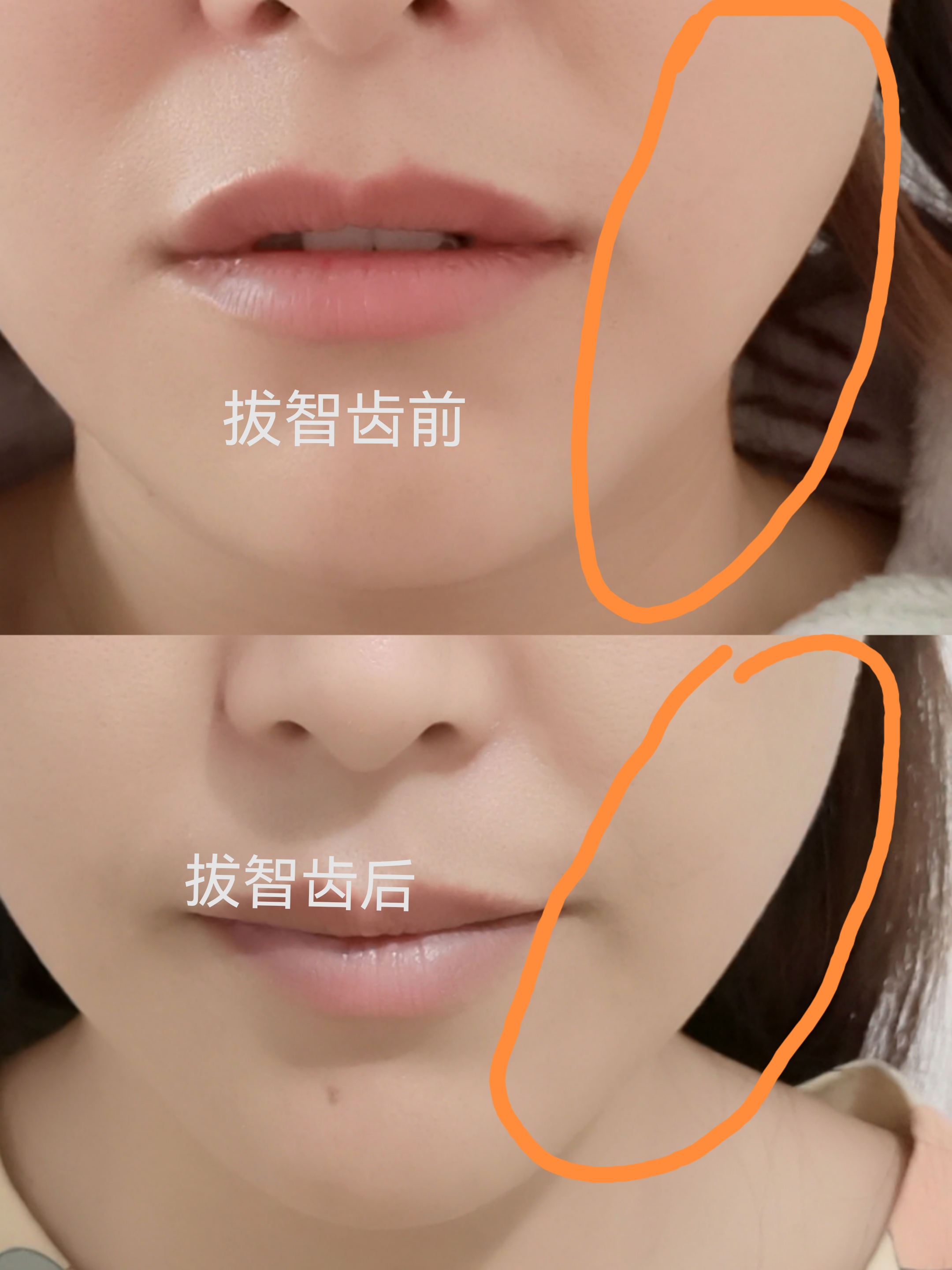 我拔智齿已经两个多月,整体对比了一下把之前和拔之后,脸确实感觉小