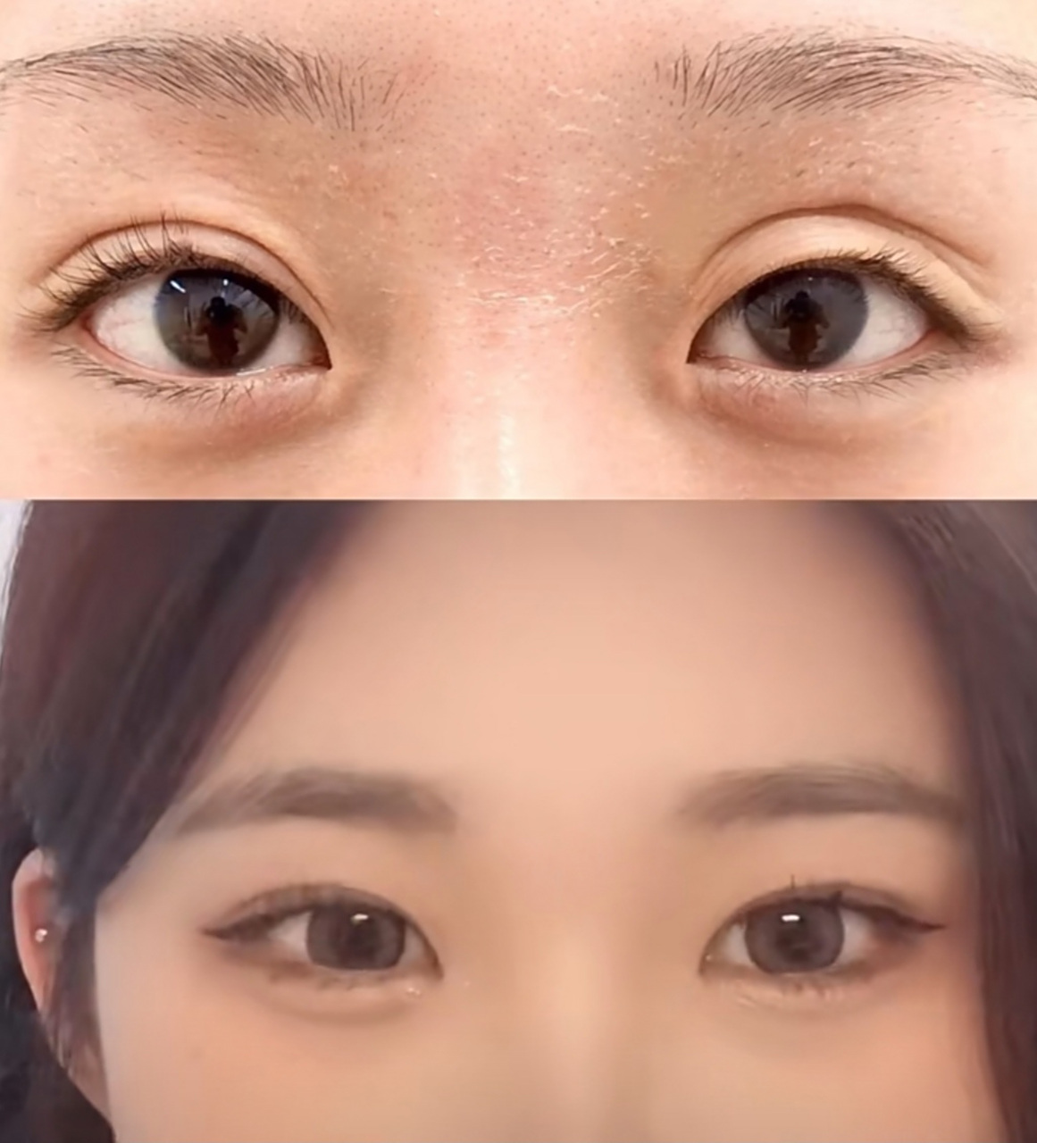 二次修复后,虽然恢复的慢,但熬过恢复期,双眼皮自然妈生,可以宣布成功