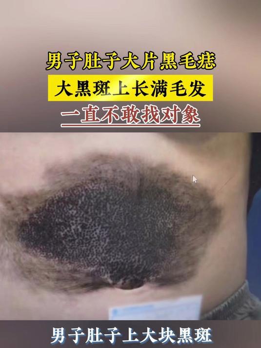 男子肚子大片黑毛痣,大黑斑上长满毛发,一直不敢找对象