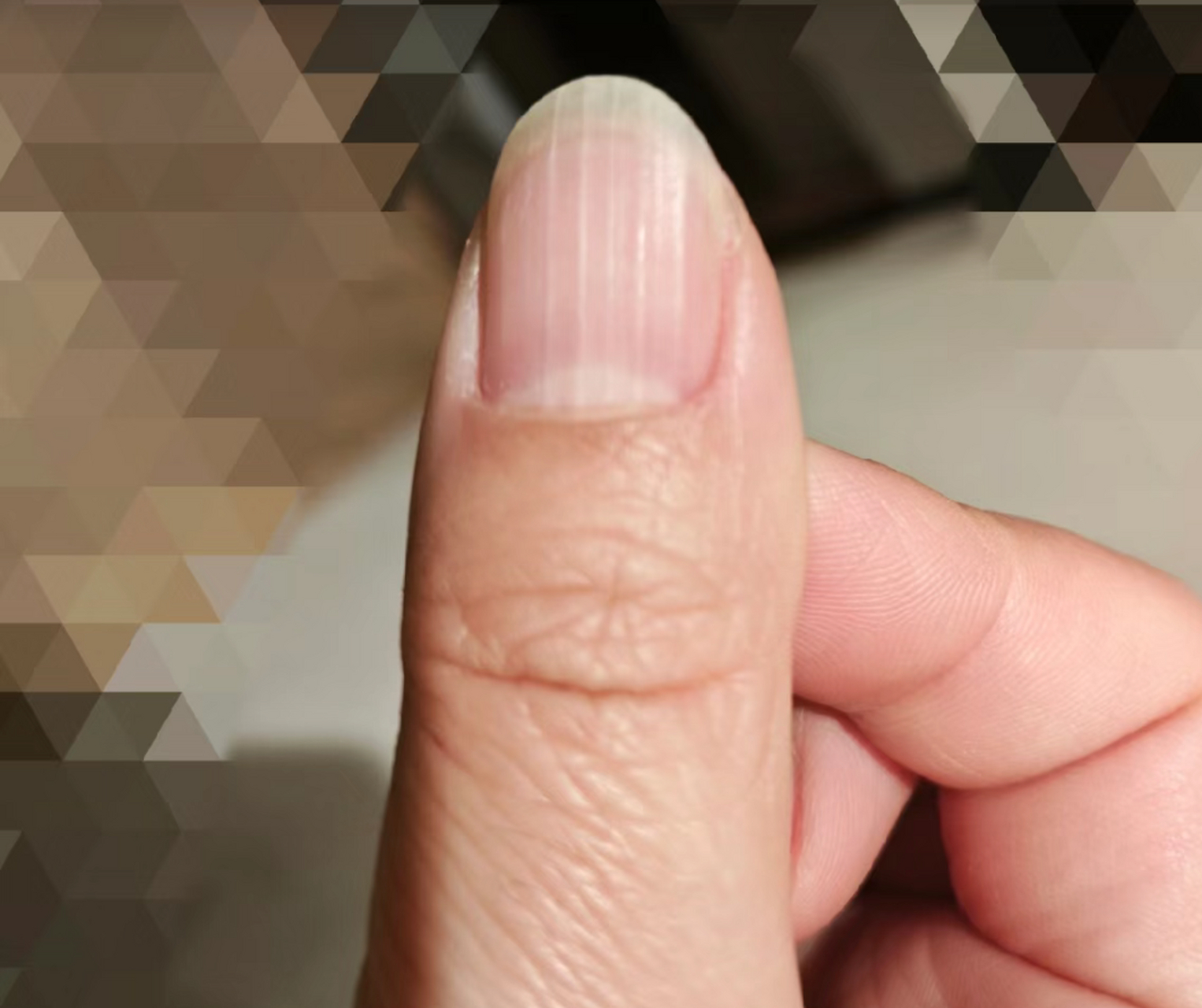 指甲好多竖纹怎么回事 每个指田上都有竖纹,但是大拇指最严重,其他的