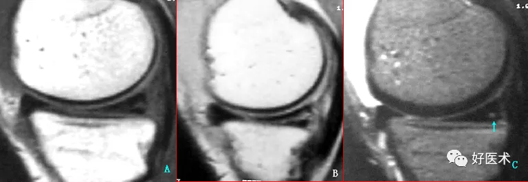 层层深入图文详解半月板mri解剖诊断,必备收藏贴!