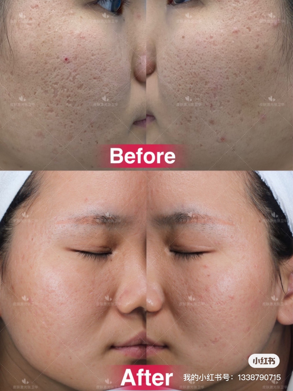 严重车厢型加深锥型痘坑一组点阵激光治疗后效果对比#点阵激光