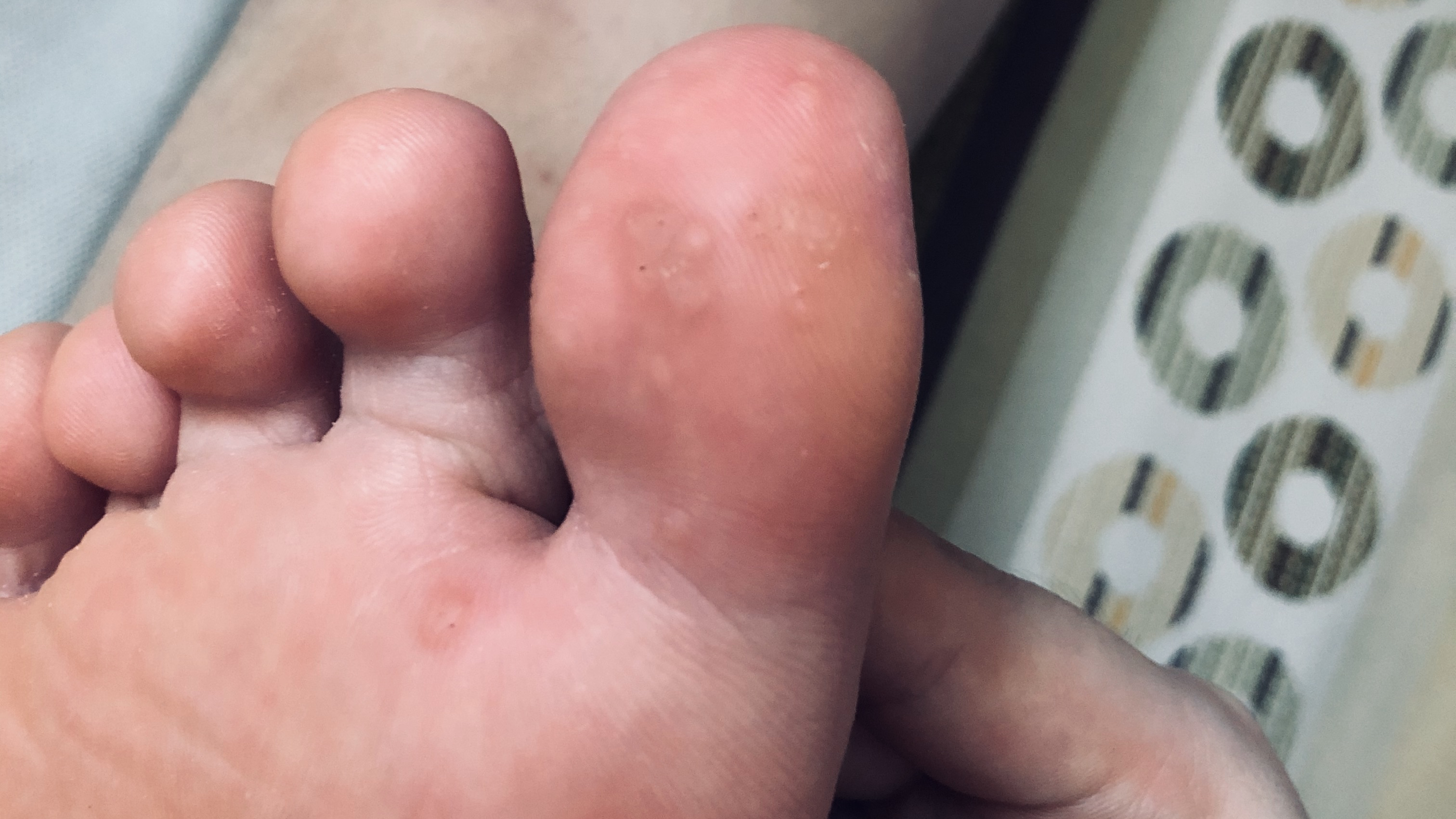 脚上出现疣该如何处理?孙医生带你皮肤科体验液氮冷冻