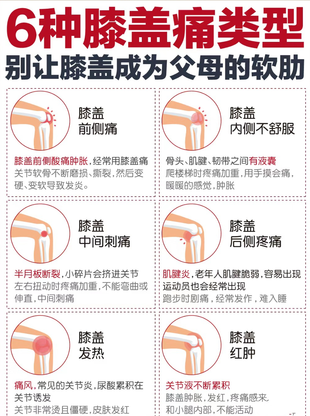 六种引起膝关节疼痛的病  第一种是膝关节炎,一般在50岁以上,多以老年
