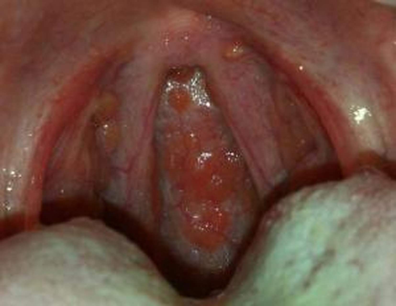 急慢性咽炎还是滤泡性咽炎,推荐一个治疗急慢性咽炎的很好的方子:升麻