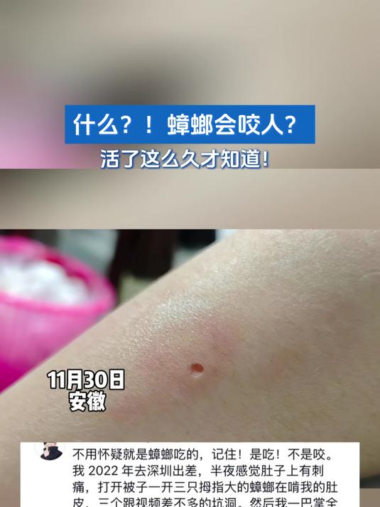 蟑螂会咬人?活了这么久才知道!