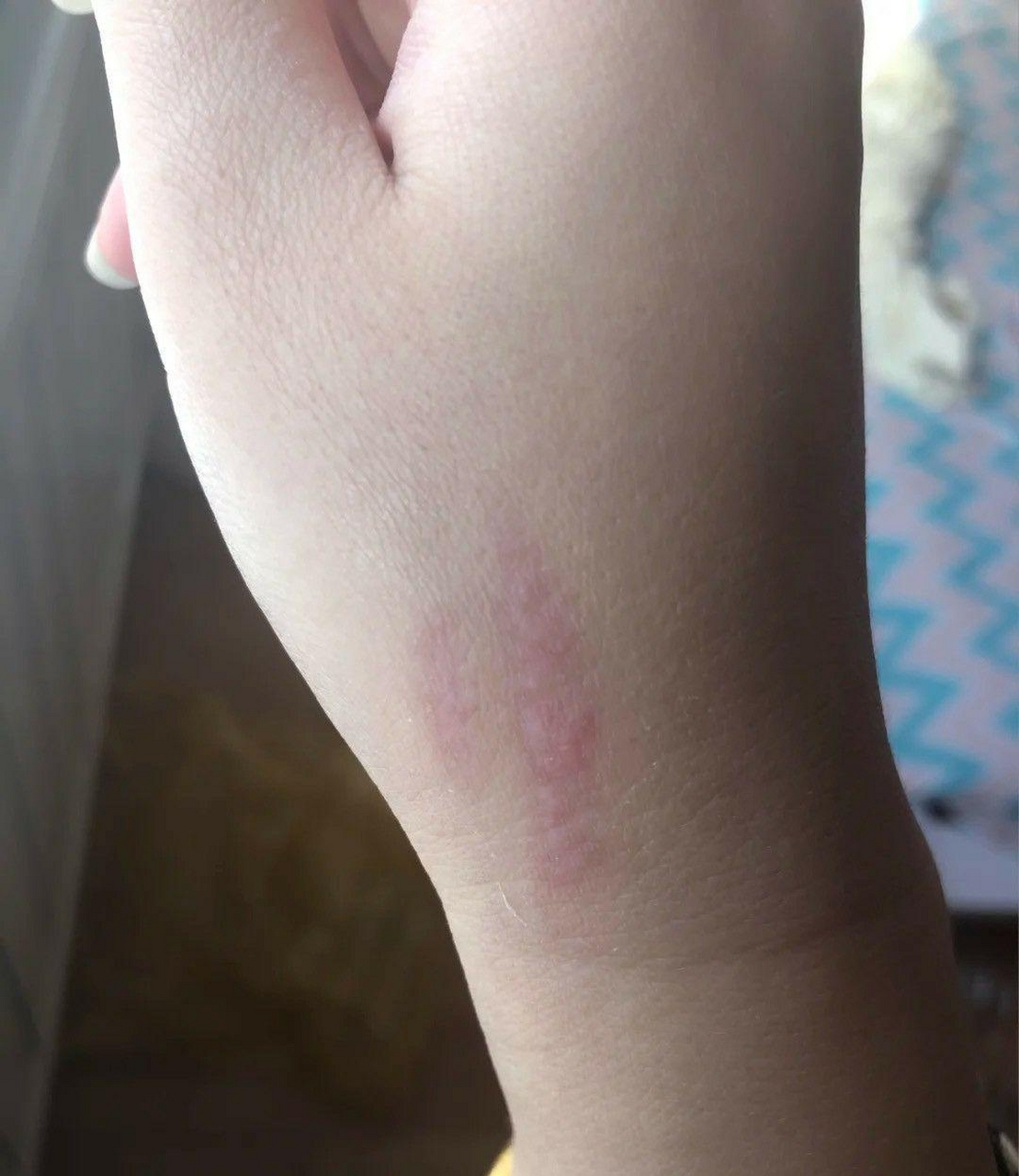 红色疤痕的形成是由于血管增生所致,通常会在创伤愈合后3-6个月内出现