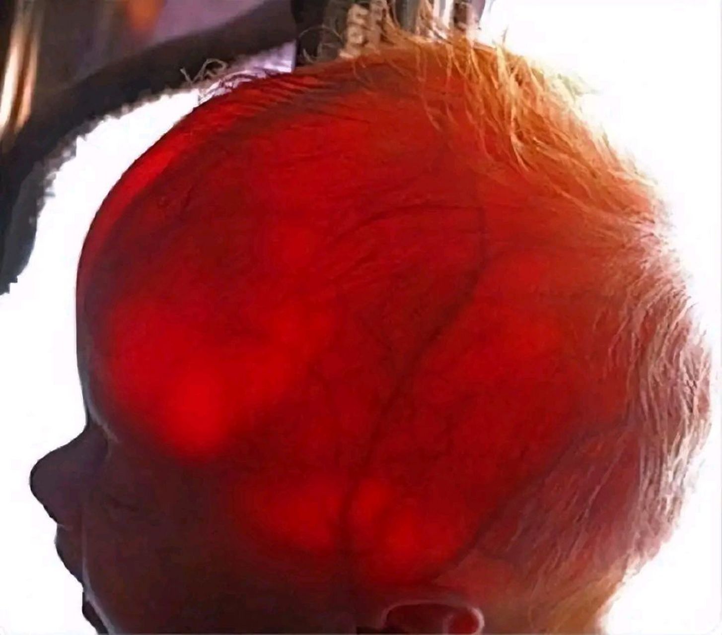 一张照片一个故事# 患有脑积水这种罕见疾病的新生儿的颅腔内充满了