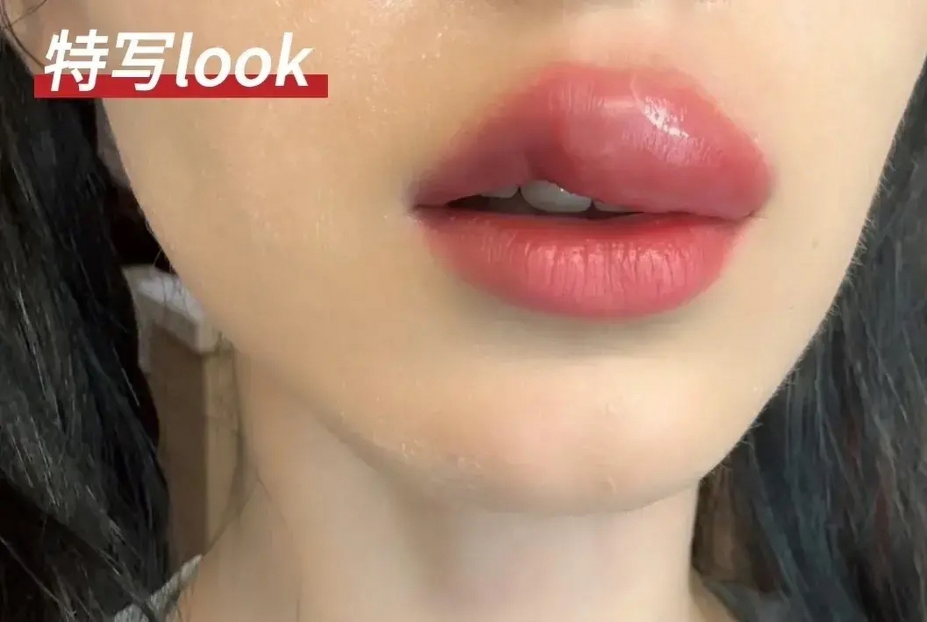 哈尼克孜晒被蚊子咬的照片,整个上嘴唇都肿了.