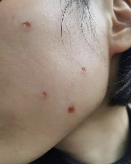 在进行激光点痣治疗后,通常会在痣上形成一层薄薄的结痂.