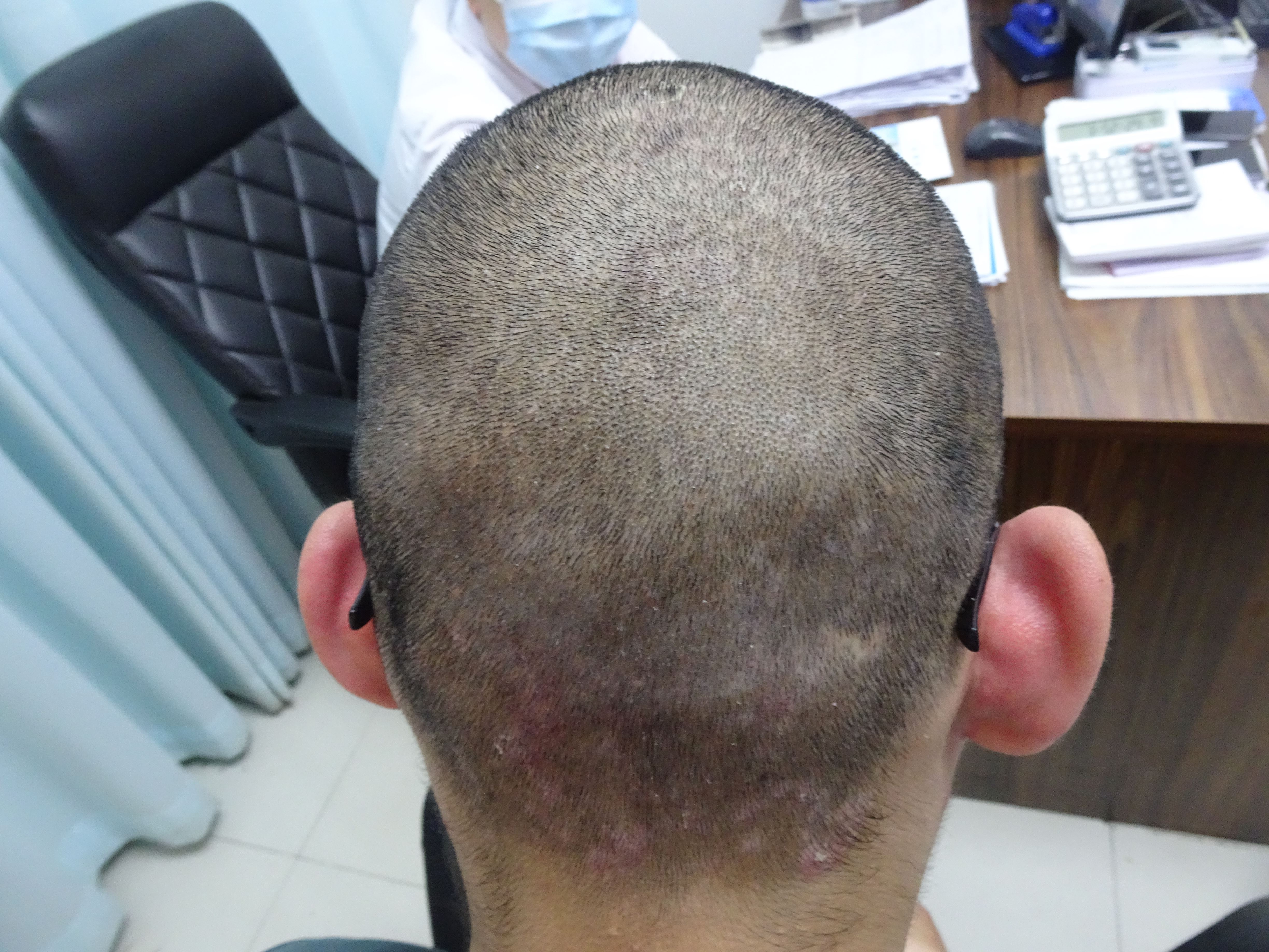 头上牛皮藓 洗一下 轻松很多 再洗洗 就这么不见了