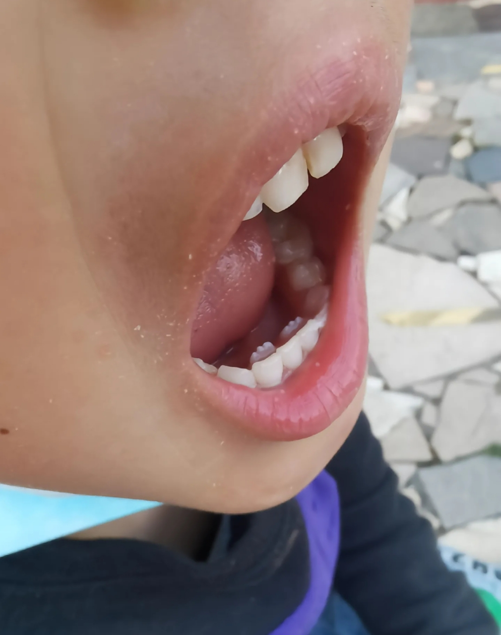 这种情况,需要拔牙吗?