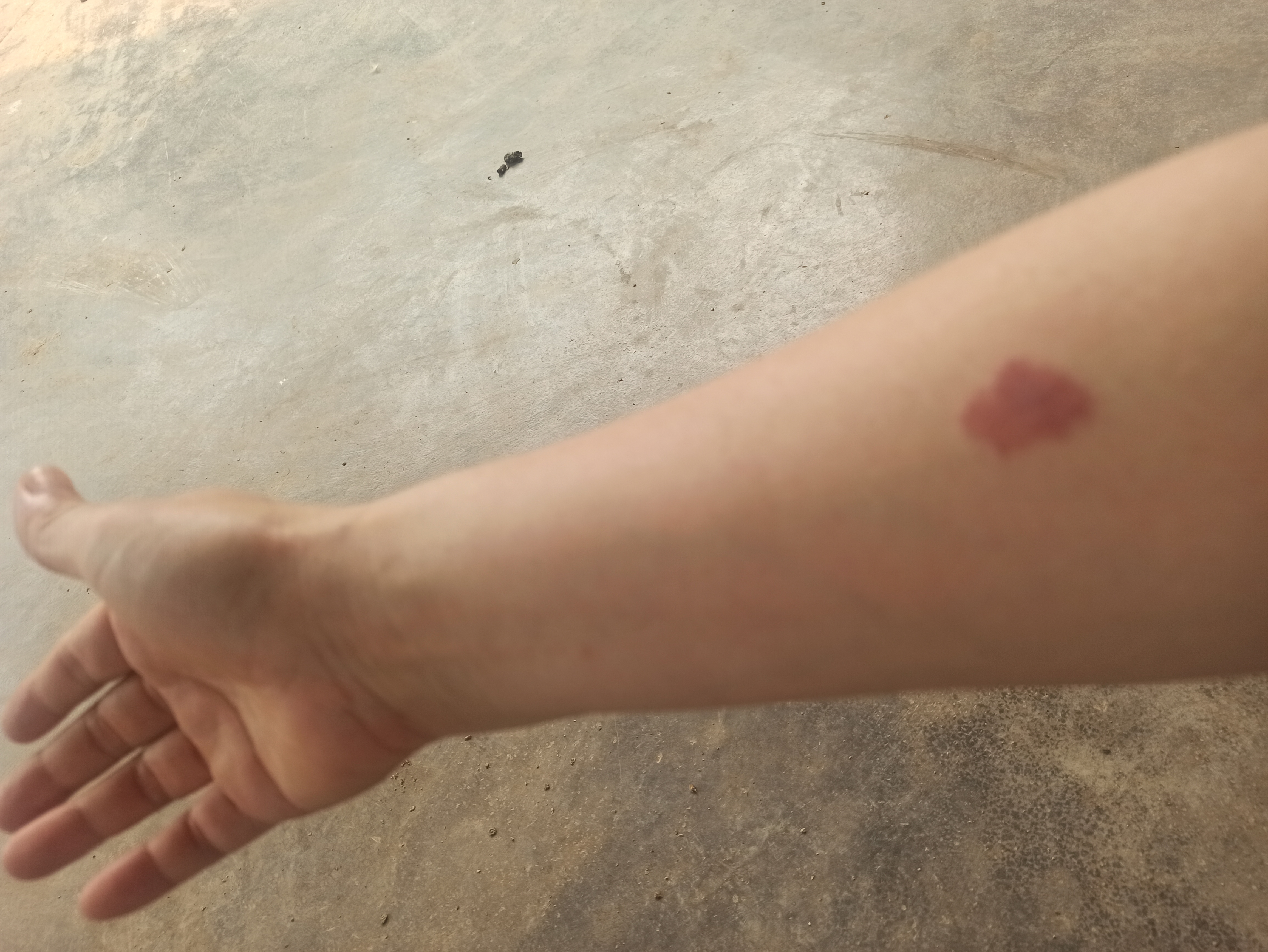 我说,我很好,这个红印是胎记,它一直在我手臂