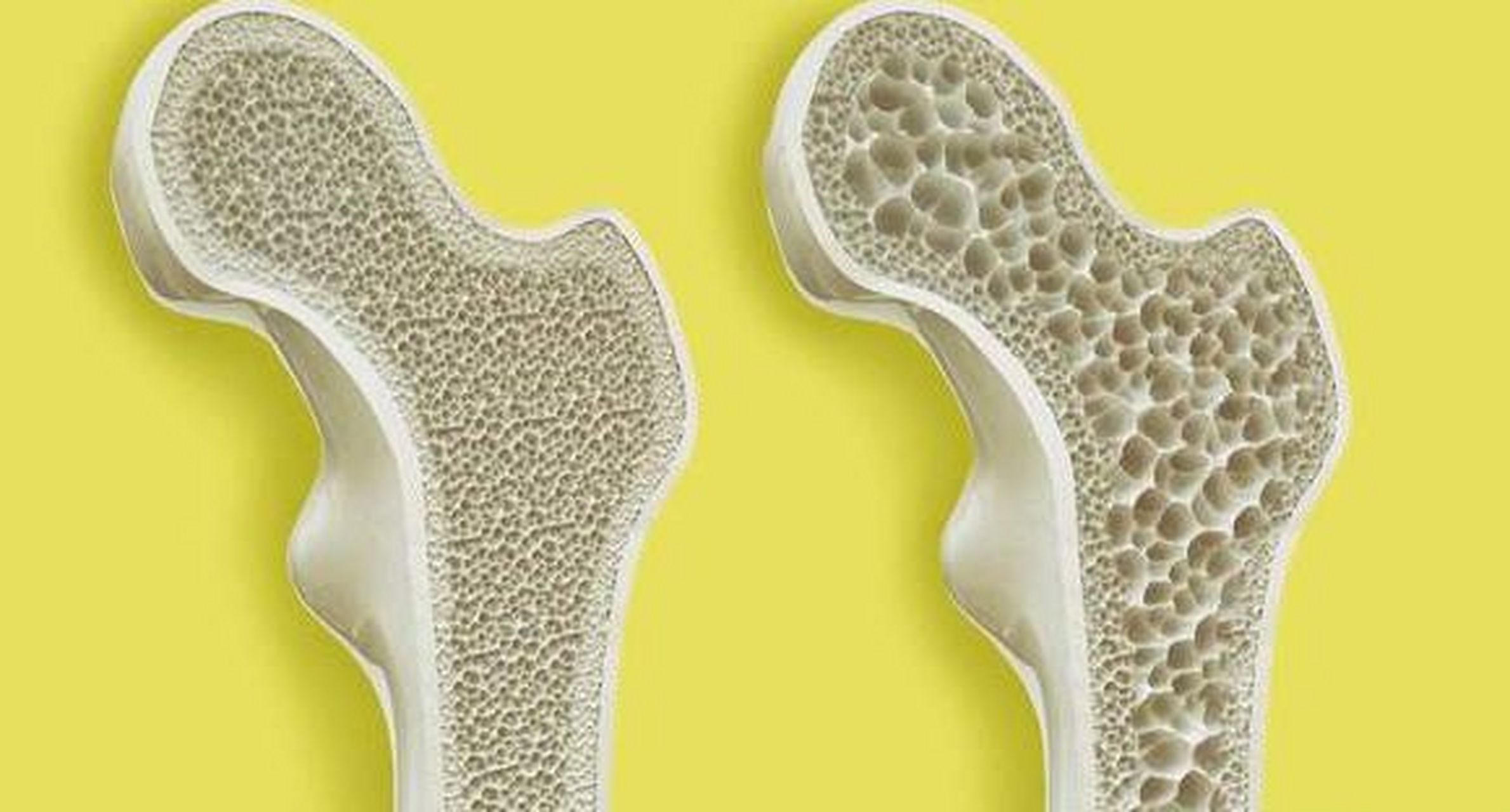 骨质疏松是糖尿病患者常见的一种并发症,但是很多人容易忽视.