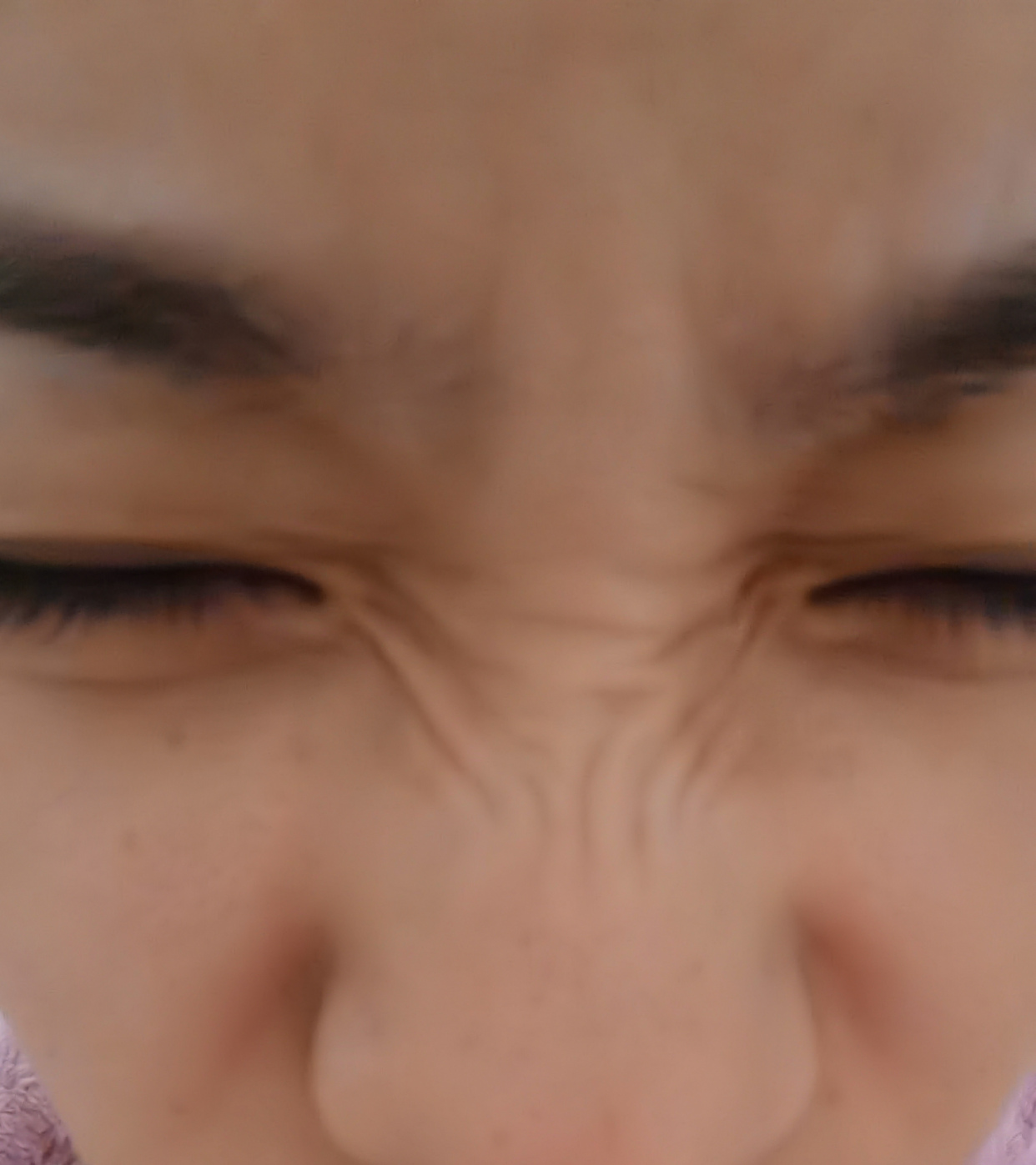 鼻背纹:面部除皱初体验