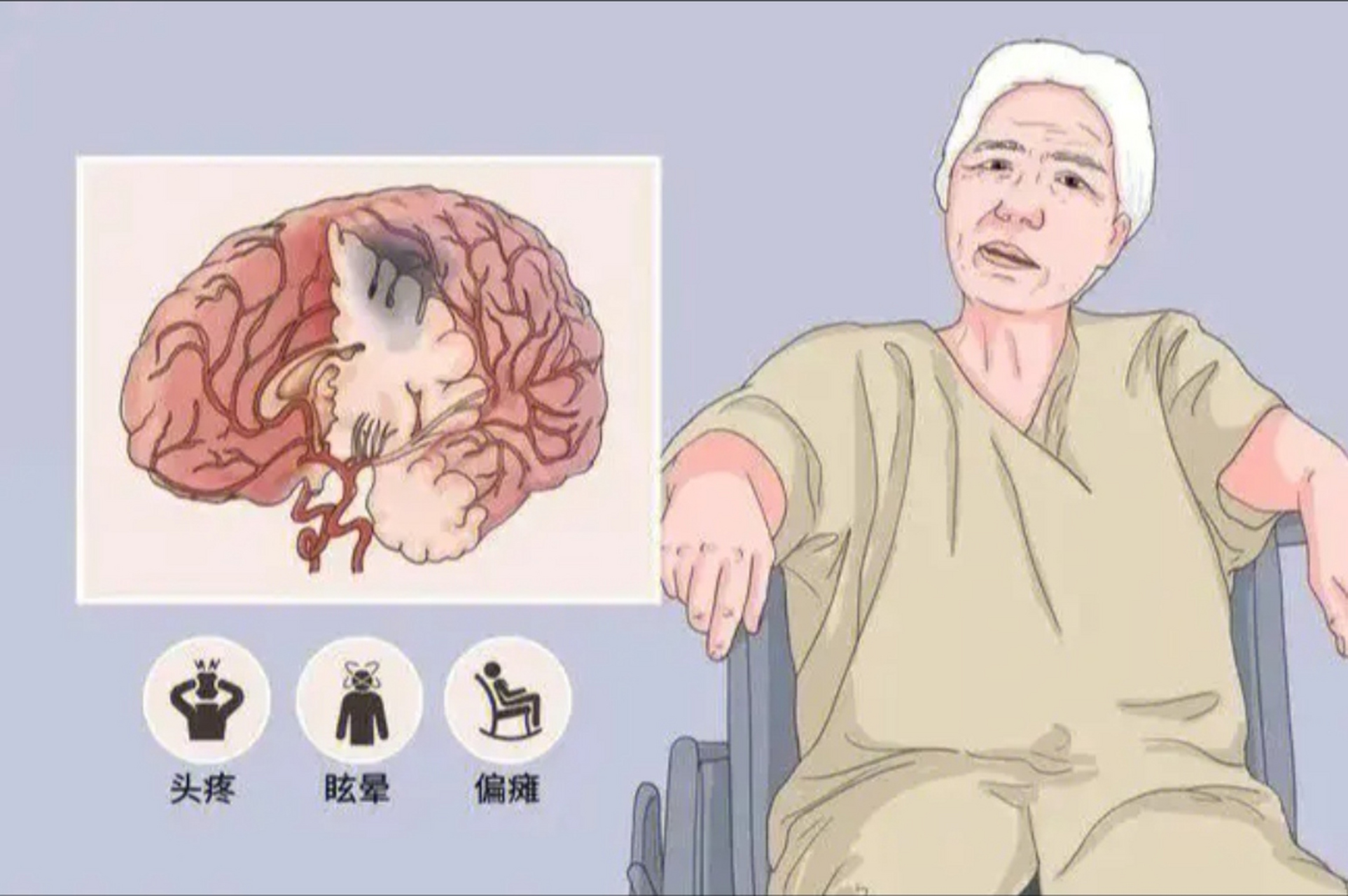 脑梗后遗症引发的肢体麻木,经过中医一方调理,现在可以去公园遛弯
