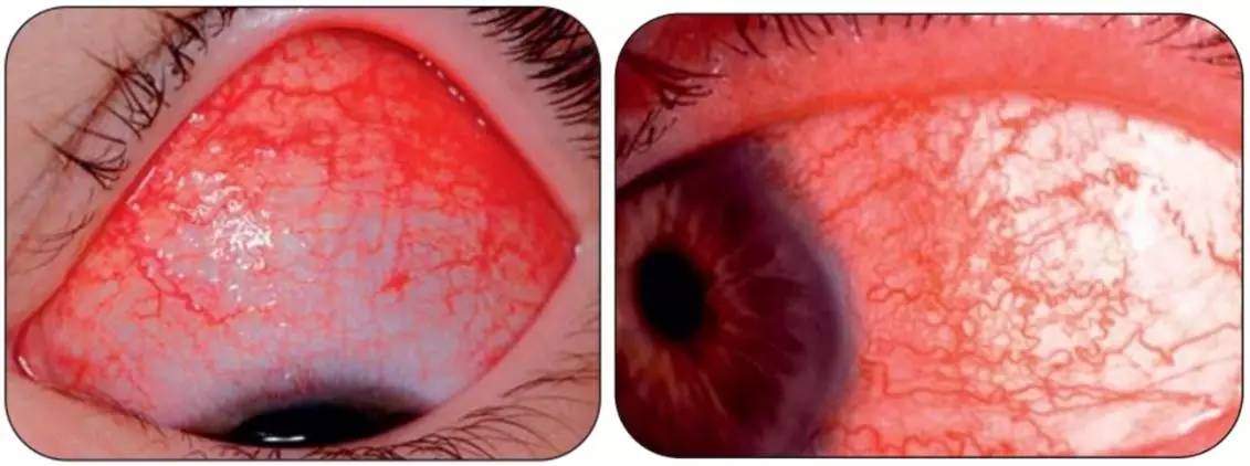 其实这样的病症称为球结膜下出血,可以直观地看到白眼球充血发红