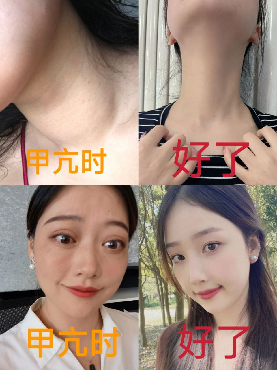 甲亢前后对比