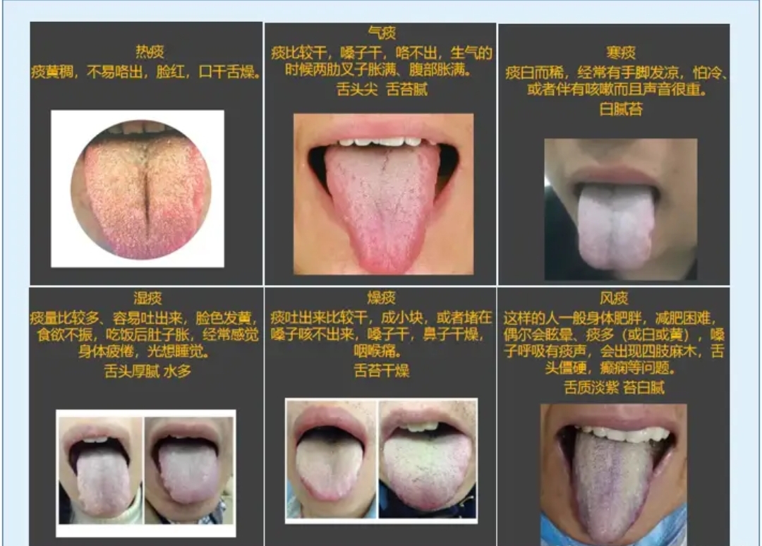 吐黄痰,白痰,黏痰中医辨证,咳痰也分型,您的情况是哪种?