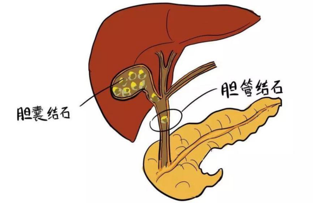 以前都是保胆取石